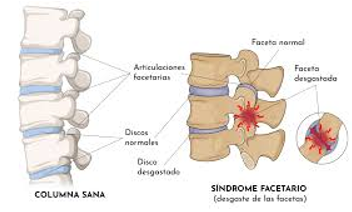 Paciente con dolor de rodilla por síndrome facetario lumbar y tratamiento conservador